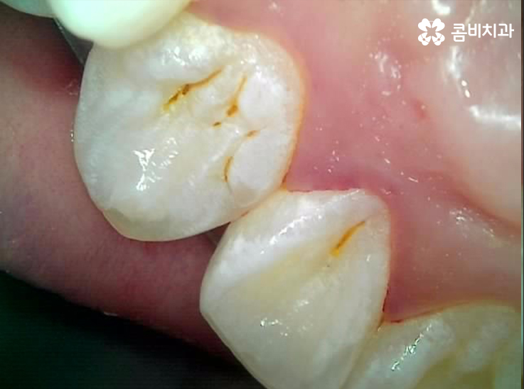 앞니 충치치료 개인에 따라 달라지는 이유 관련 이미지 6