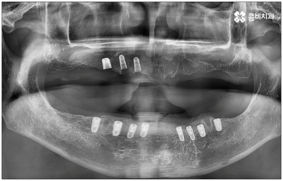 노인임플란트 참고사항 알아봐요 관련 이미지 9