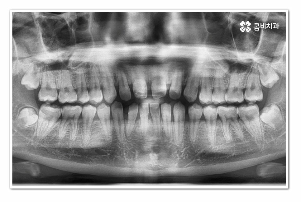앞니 벌어짐 똑똑하게 해결하려면 관련 이미지 6