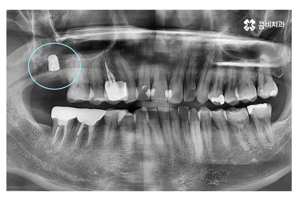 20대임플란트 잦아지는 이유를 알아본다면 관련 이미지 2