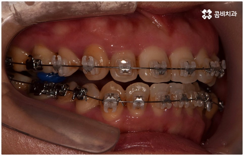 반대교합교정 늦지 않았어요 관련 이미지 7