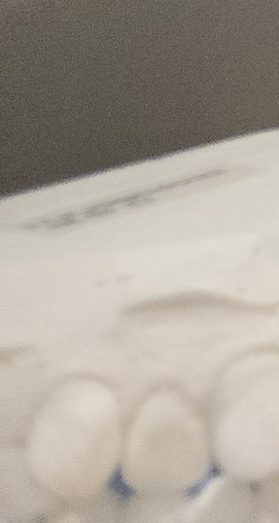 앞니 틀어짐 부분교정 얼마나 걸릴까 관련 이미지 41