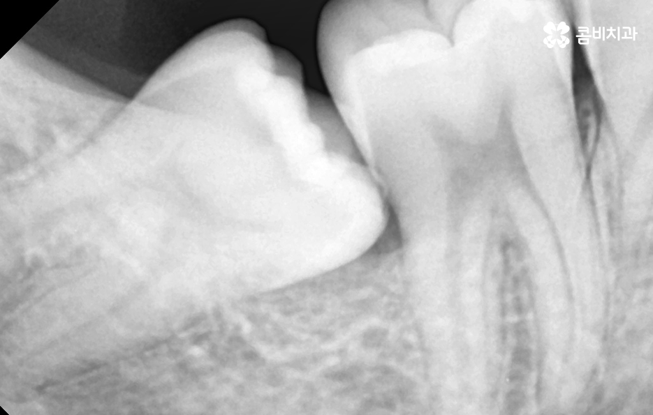 부분매복 사랑니 발치 신중하게 대비하려면 관련 이미지 5