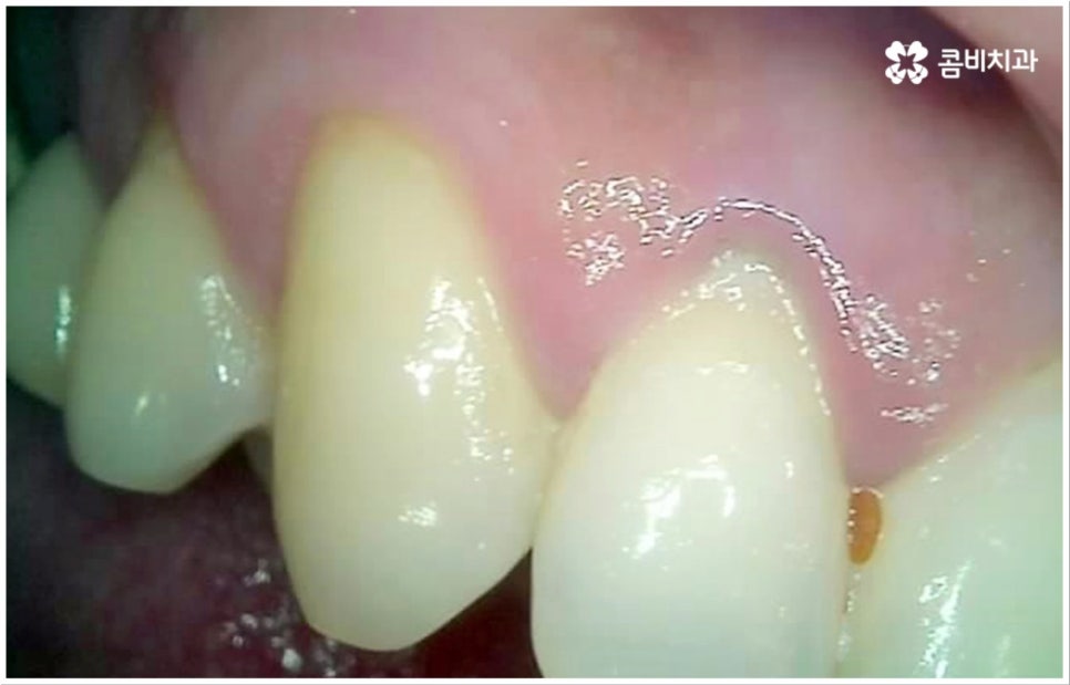 충치 통증 참지마세요 관련 이미지 4