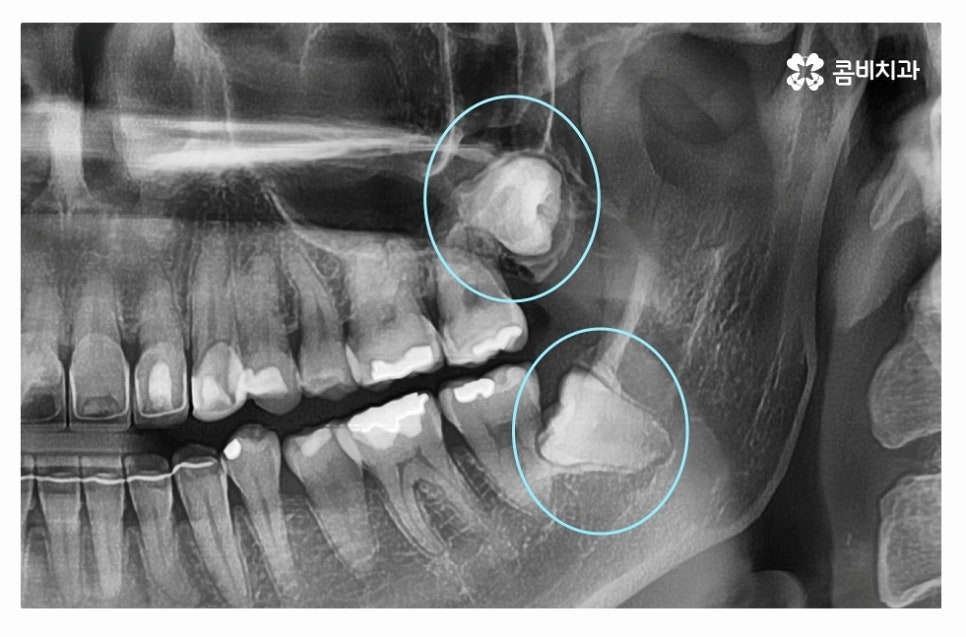 누운사랑니발치 언제 뽑을지 고민이라면 관련 이미지 6