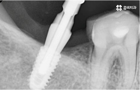 명동치과 타고난 이의 수명은 관련 이미지 14
