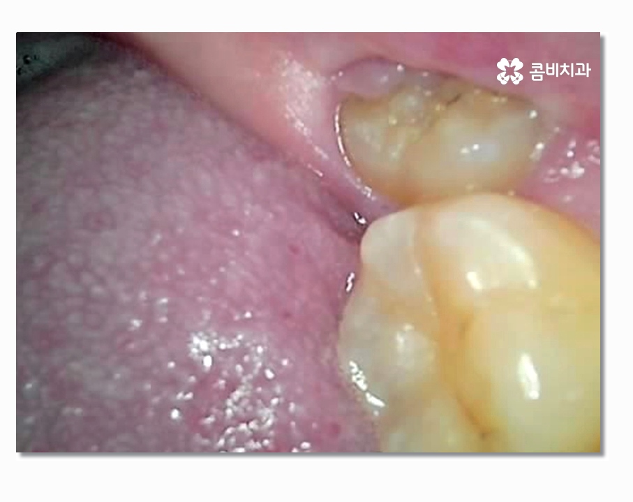 부분매복사랑니 언제 뽑아야 할까 관련 이미지 6