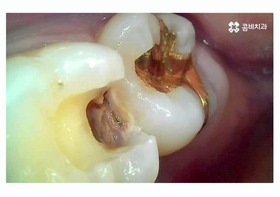 충치 떼우기 스무살이후에 조심해야 할 점은? 관련 이미지 8