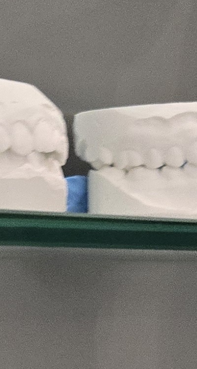 사랑니 주변 잇몸 통증 지금부터가 중요하니까 관련 이미지 27