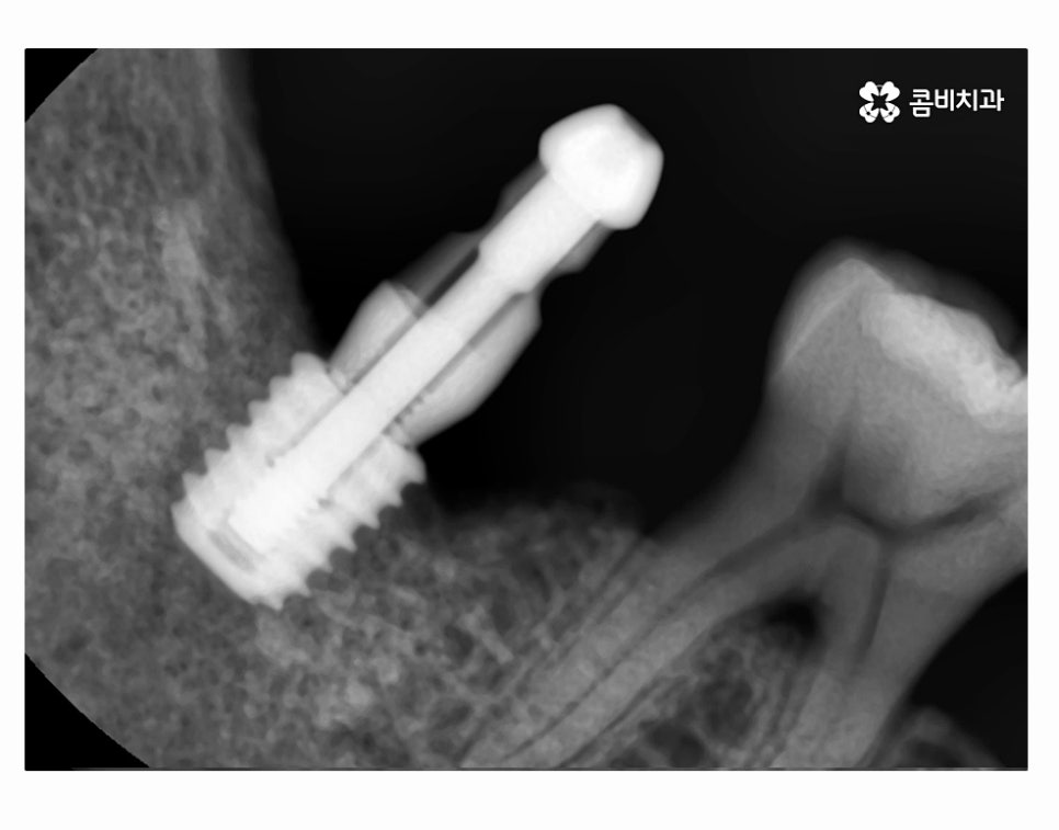 어금니 발치 심각해지기 전에 막으려면 관련 이미지 13