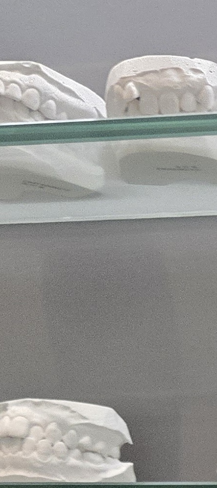 앞이빨 임플란트 과정 주의해야할 포인트는 관련 이미지 11