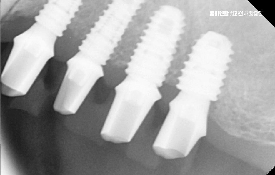 임플란트 뼈이식 안하면 어떤 문제가 있는거죠 관련 이미지 8