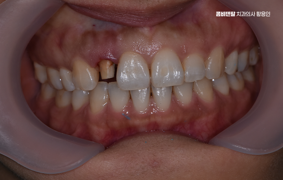 앞니 올세라믹 이건 알고 시작하세요 관련 이미지 3