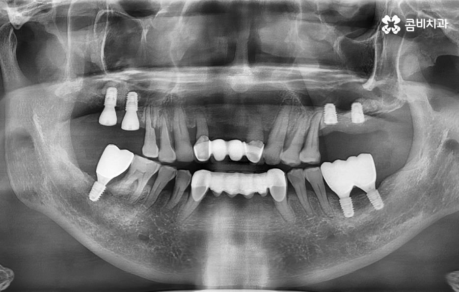 50대임플란트 각별하게 주의해야 하는 시기 관련 이미지 14