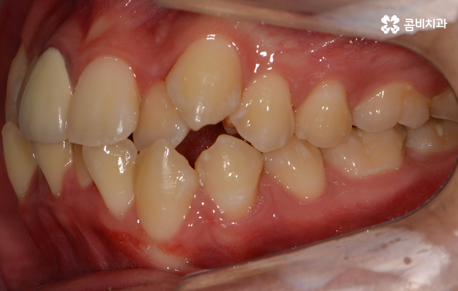 덧니교정 불편함이 느껴지지 않더라도 관련 이미지 3