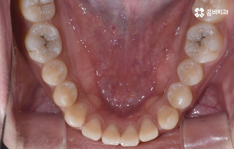 앞니만 교정 과잉치 뽑아서 해결했어요 관련 이미지 6