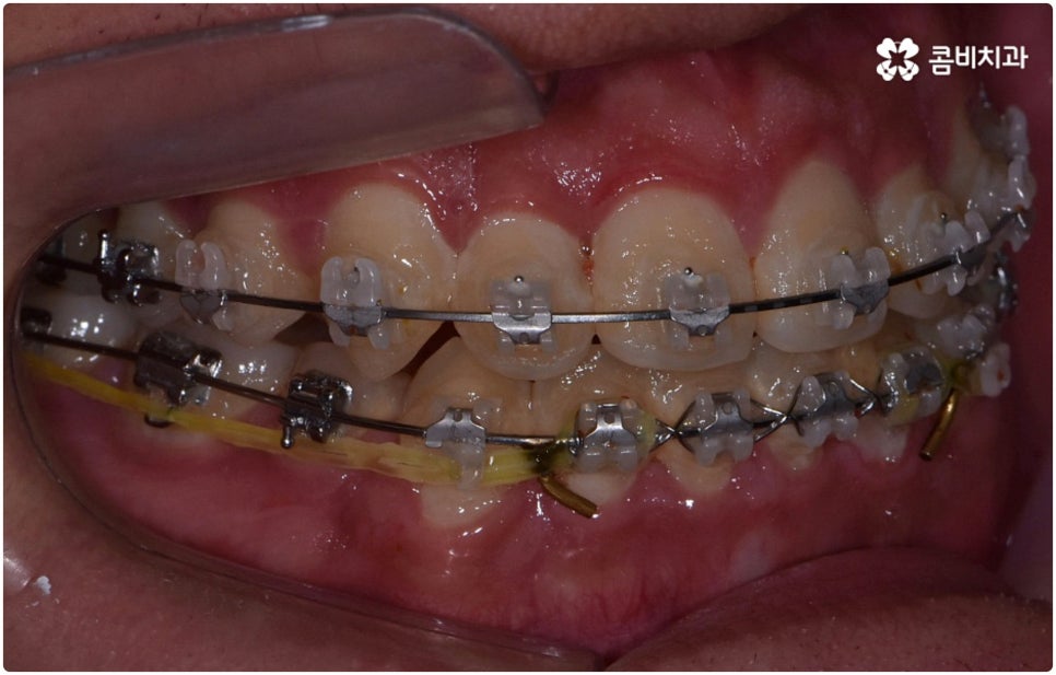 부정교합 3급 고치는 방법은 관련 이미지 10