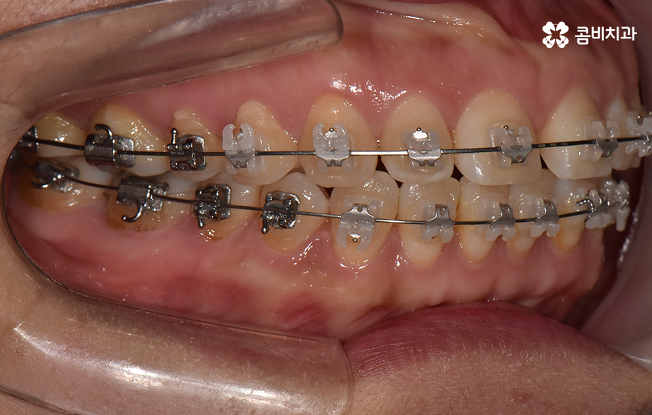 중년치아교정 이제라도 해도 될까요 관련 이미지 8