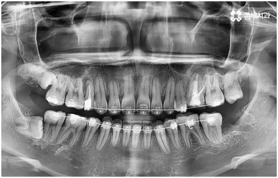 매복사랑니발치치과 어디로 가나요? 관련 이미지 8