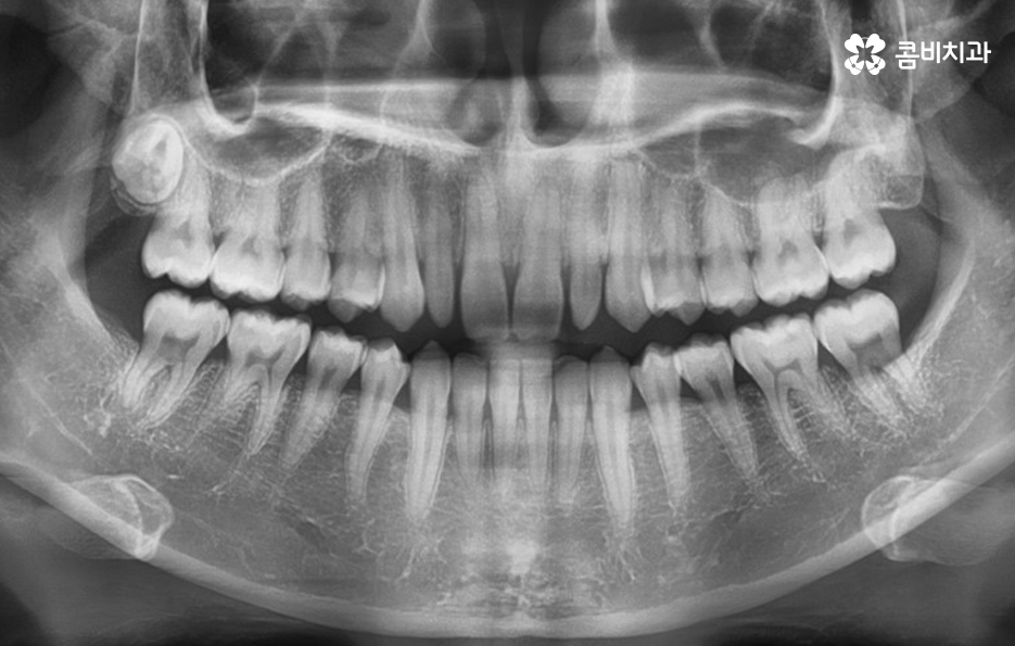 앞니 깨짐 치료와 교정이 병행되었던 사례 관련 이미지 4
