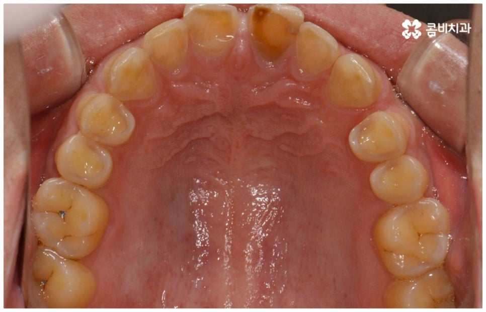 앞니충치치료 어떻게 이뤄지나요 관련 이미지 4
