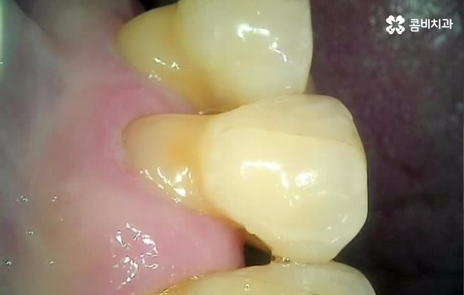 50대임플란트 각별하게 주의해야 하는 시기 관련 이미지 4