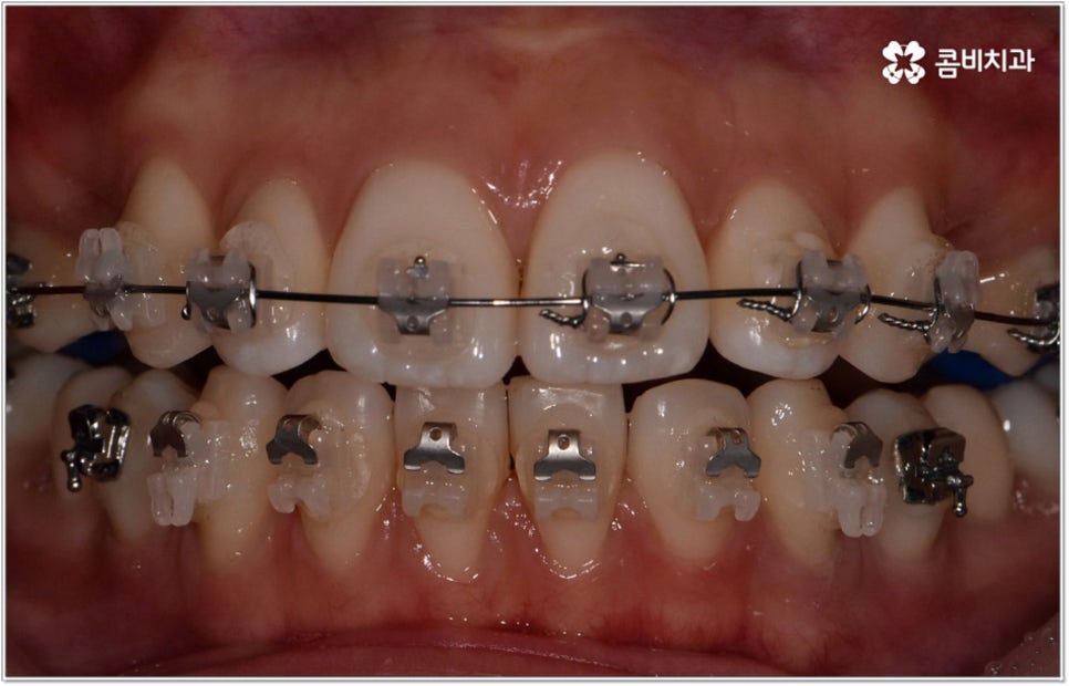 돌출입치아교정 언제가 적기인가요? 관련 이미지 3