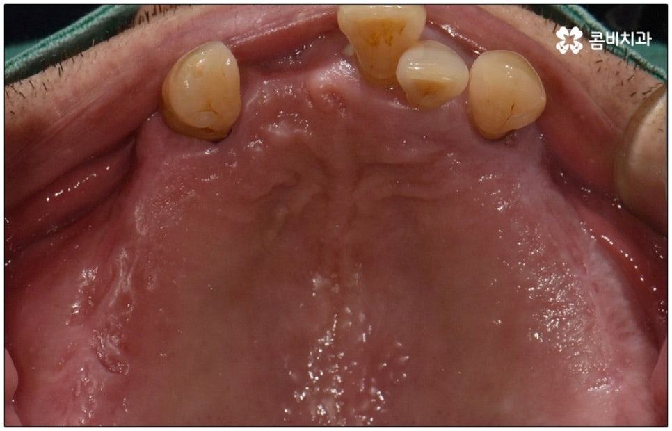 노인임플란트 참고사항 알아봐요 관련 이미지 7