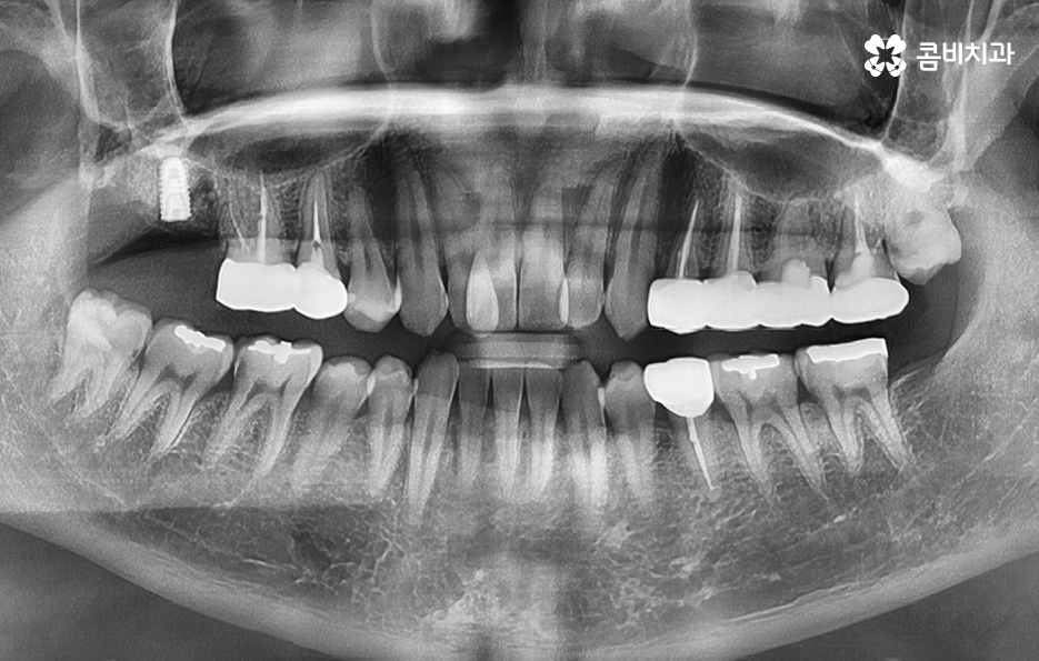 어금니 충치 발치 결국 뽑아야 할때와 살릴 수 있는 케이스 관련 이미지 4
