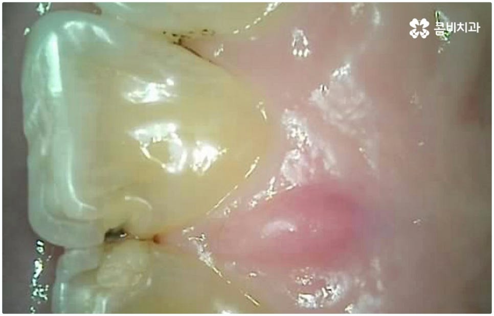 원데이임플란트 받고 싶으신가요? 관련 이미지 8