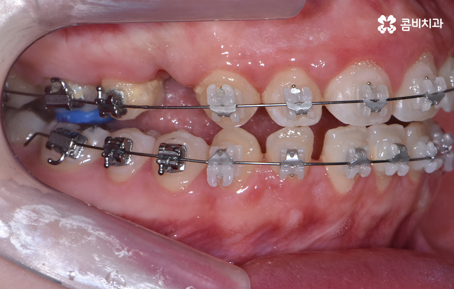치아 벌어짐 교정으로 앞니 돌출까지 해결하기 관련 이미지 7