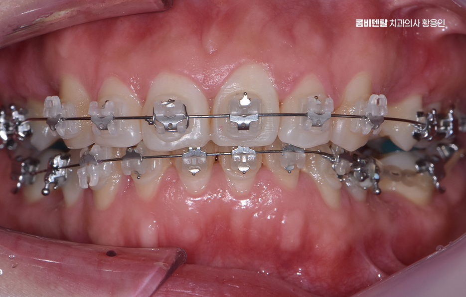 돌출입 팔자주름 교정 얼마나 바뀔까요 관련 이미지 6