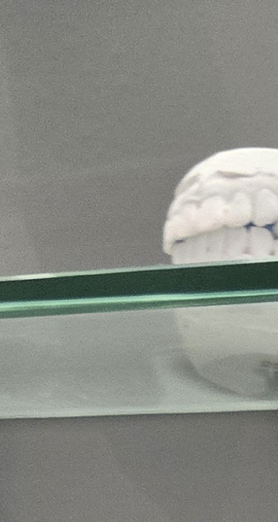 윗니 전체 임플란트 뭐부터 해야할까 관련 이미지 13