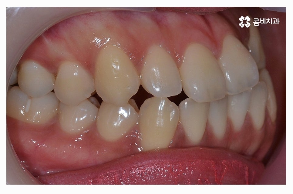 덧니교정 정교하게 따져보려면 관련 이미지 2