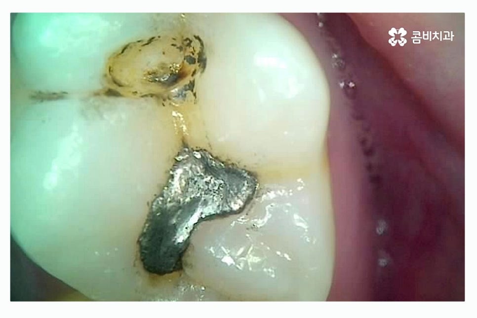 충치 레진 인레이 합리적으로 결정하려면 관련 이미지 5