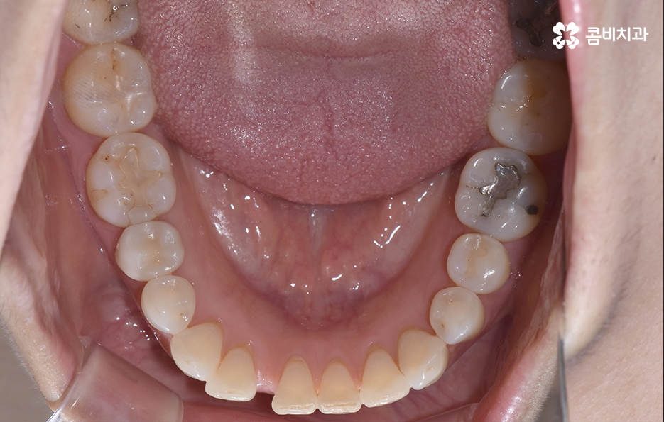 중년치아교정 이제라도 해도 될까요 관련 이미지 6