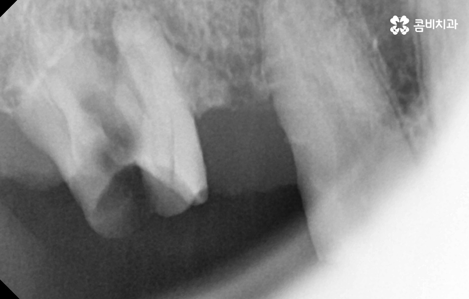 65세이상 임플란트 개수 구체적으로 체크하려면 관련 이미지 4