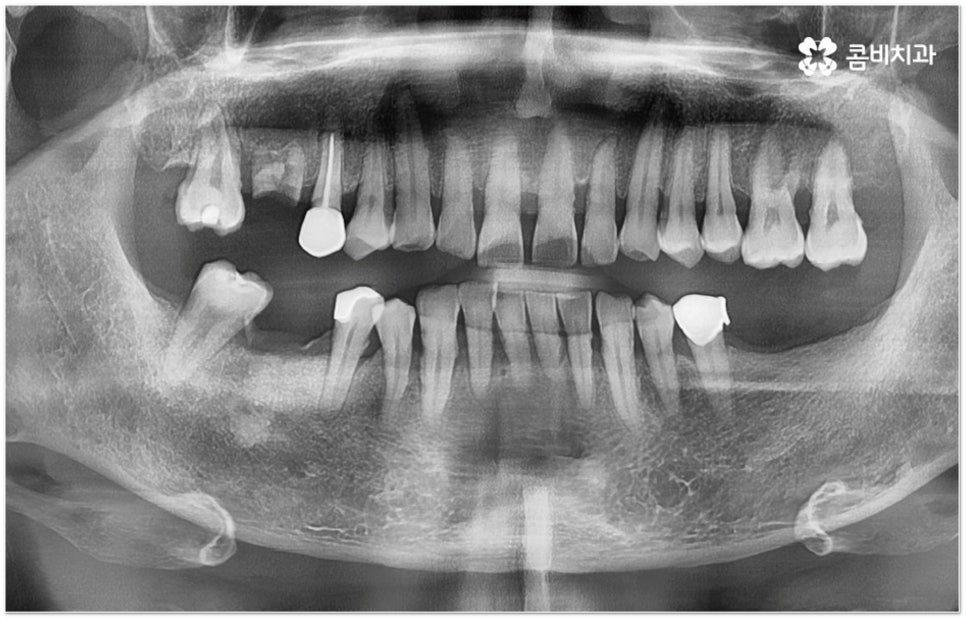 뼈이식임플란트 언제하나요? 관련 이미지 3