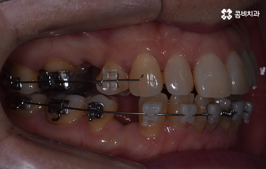 돌출입 콤비교정으로 얼굴까지 개선하는 방법은 관련 이미지 8