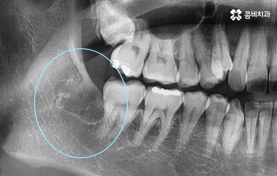 어금니 충치치료 깔끔하게 해결하려면 관련 이미지 10