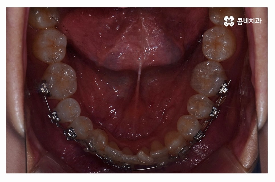 덧니교정 체계적으로 준비하려면 관련 이미지 12