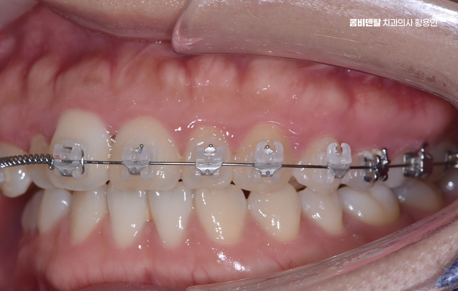 치아교정 통증 줄이는 방법 어떻게 가능할까요 관련 이미지 8