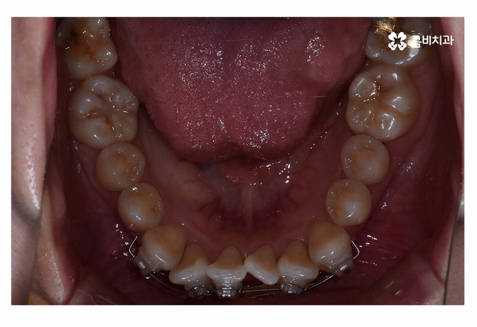 치아부분교정 나도 해당될지 궁금하다면 관련 이미지 7