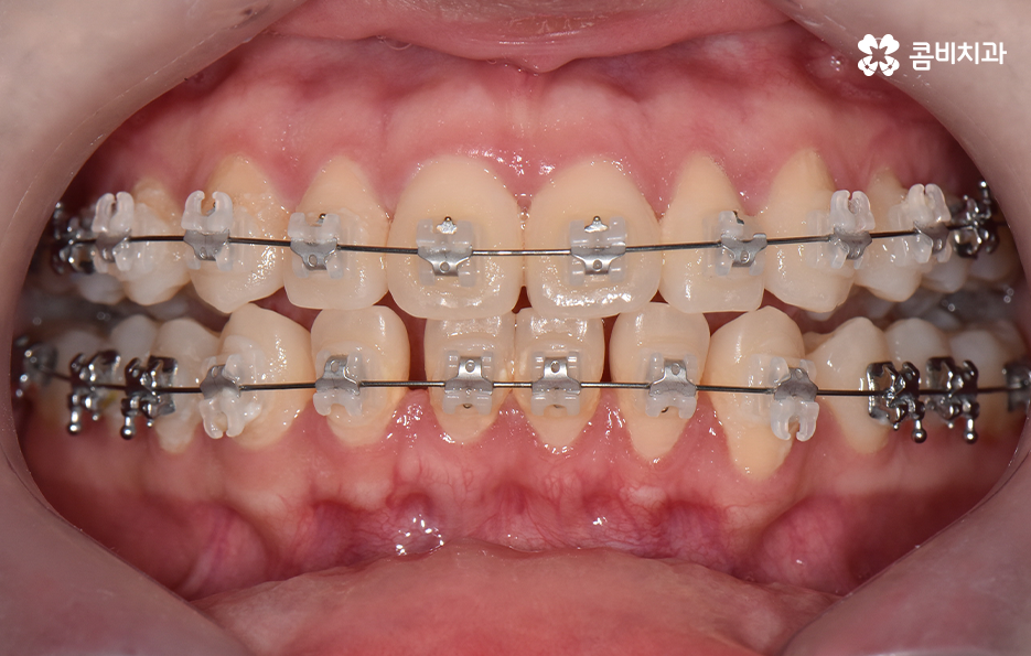 아래앞니 벌어짐 교정으로 해결했어요 관련 이미지 7