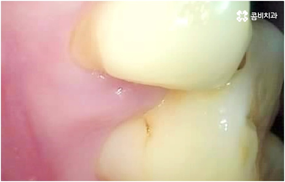 충치 단계 알아볼까요 관련 이미지 5