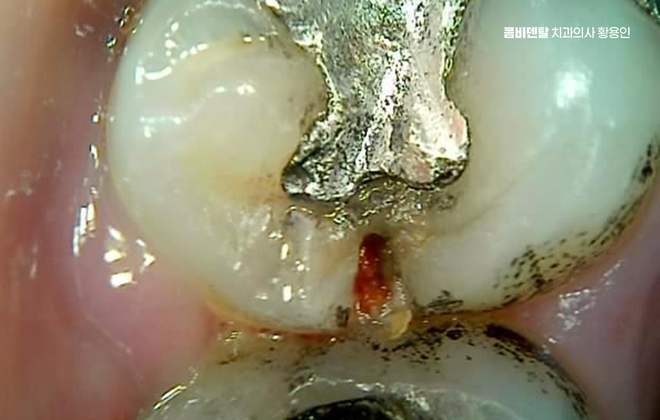 아말감 교체 레진 인레이 어떻게 대처하면 될까 관련 이미지 3