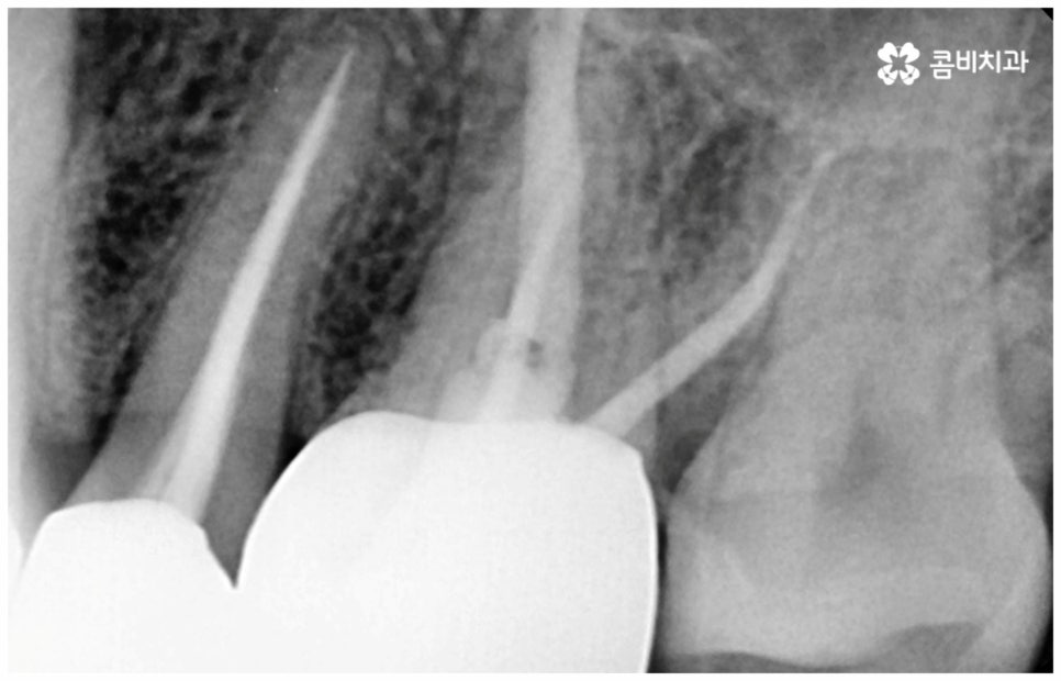 어금니신경치료 케이스마다 달라요 관련 이미지 10