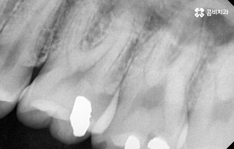 어금니 충치 깨짐 판단기준부터 세워보세요 관련 이미지 11