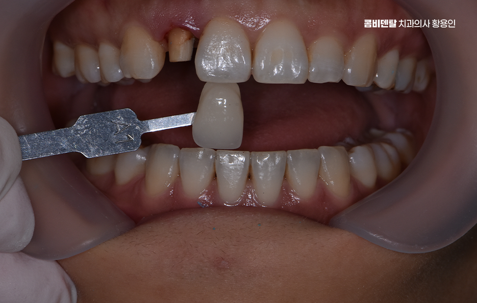 앞니 올세라믹 이건 알고 시작하세요 관련 이미지 5