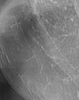 어금니 뒤 잇몸 부음 어떤 문제길래 이런거죠 관련 이미지 29